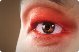 Artistic rendering of eyelid erythema