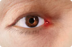 Artistic rendering of eye inflammation of the caruncle or plica