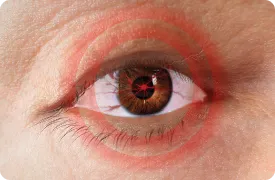 Artistic rendering of pain and pressure behind the eye