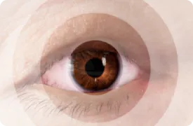 Artistic rendering of vision loss caused by Thyroid Eye Disease