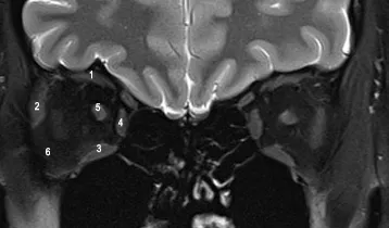 MRI scan of patient without Thyroid Eye Disease