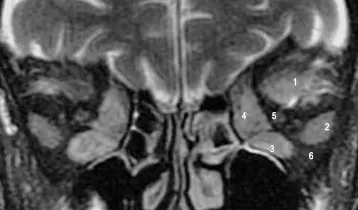 Severe Thyroid Eye Disease MRI