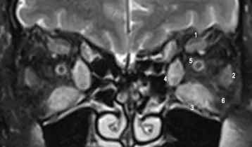 Moderate Thyroid Eye Disease MRI